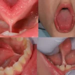 What Is Posterior Tongue-Tie? A Simple Guide for Parents