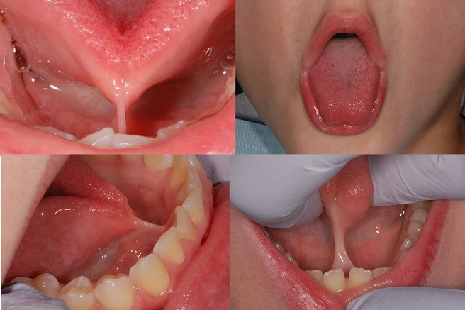 What Is Posterior Tongue-Tie? A Simple Guide for Parents