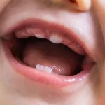 Lip-Tie in Babies: The Overlooked Cause of Breastfeeding Pain