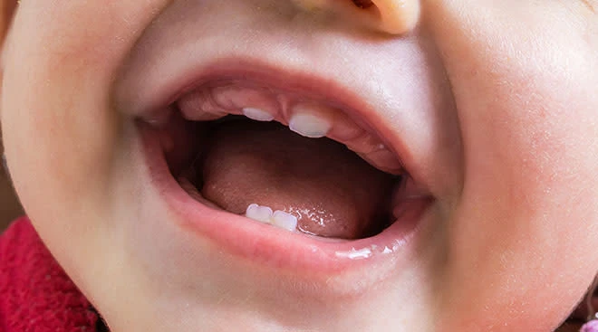 Lip-Tie in Babies: The Overlooked Cause of Breastfeeding Pain