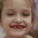 Thumb Sucking Effects on Teeth: When Should Parents Be Concerned?